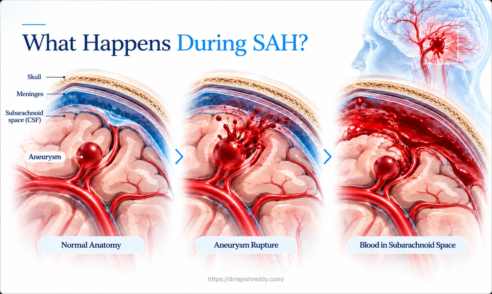 What Happens During SAH