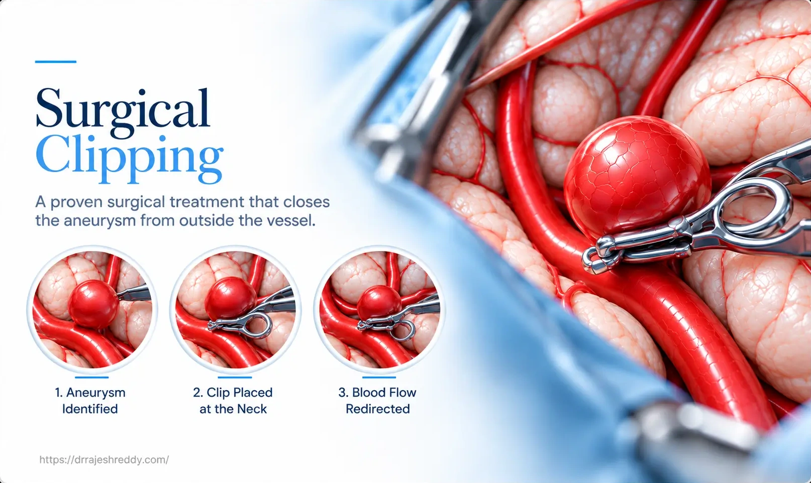 Microsurgical Aneurysm Clipping Anatomy