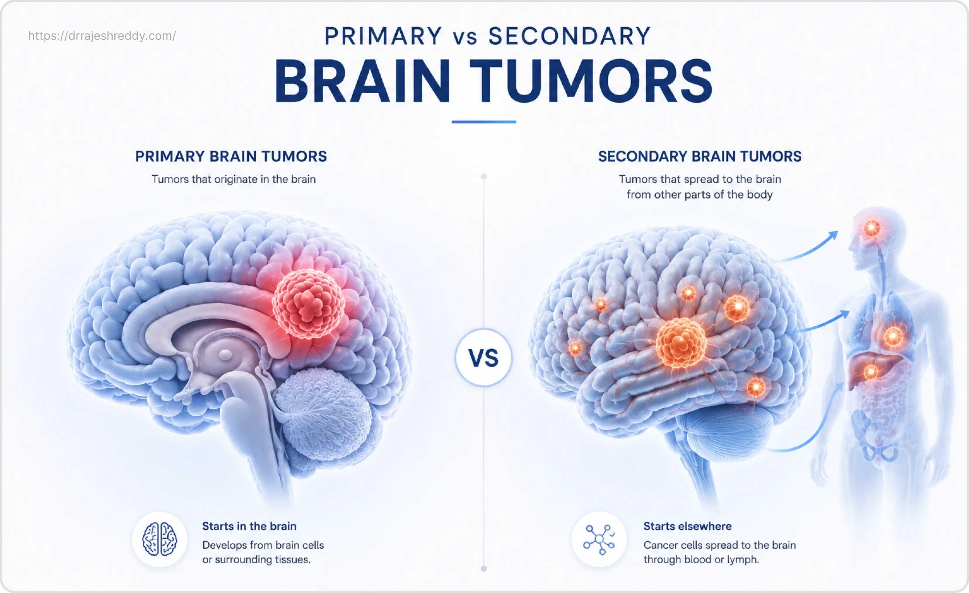 Primary vs Secondary Brain Tumors Comparison Diagram