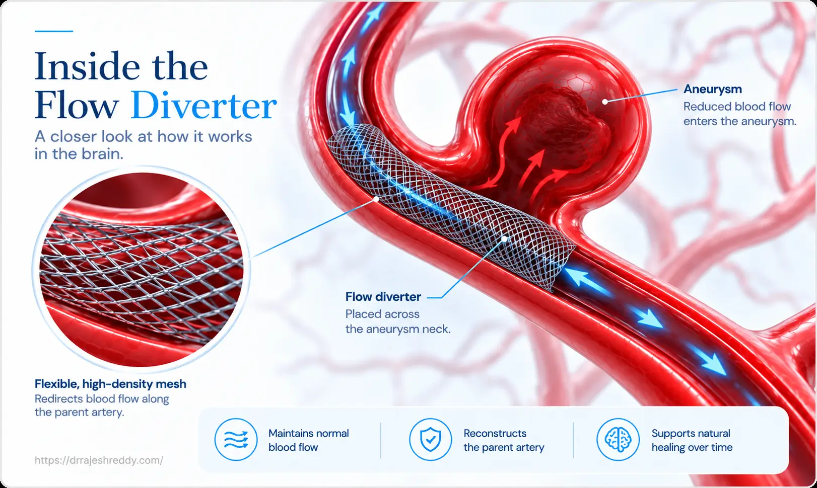 Inside Flow Diversion Procedure