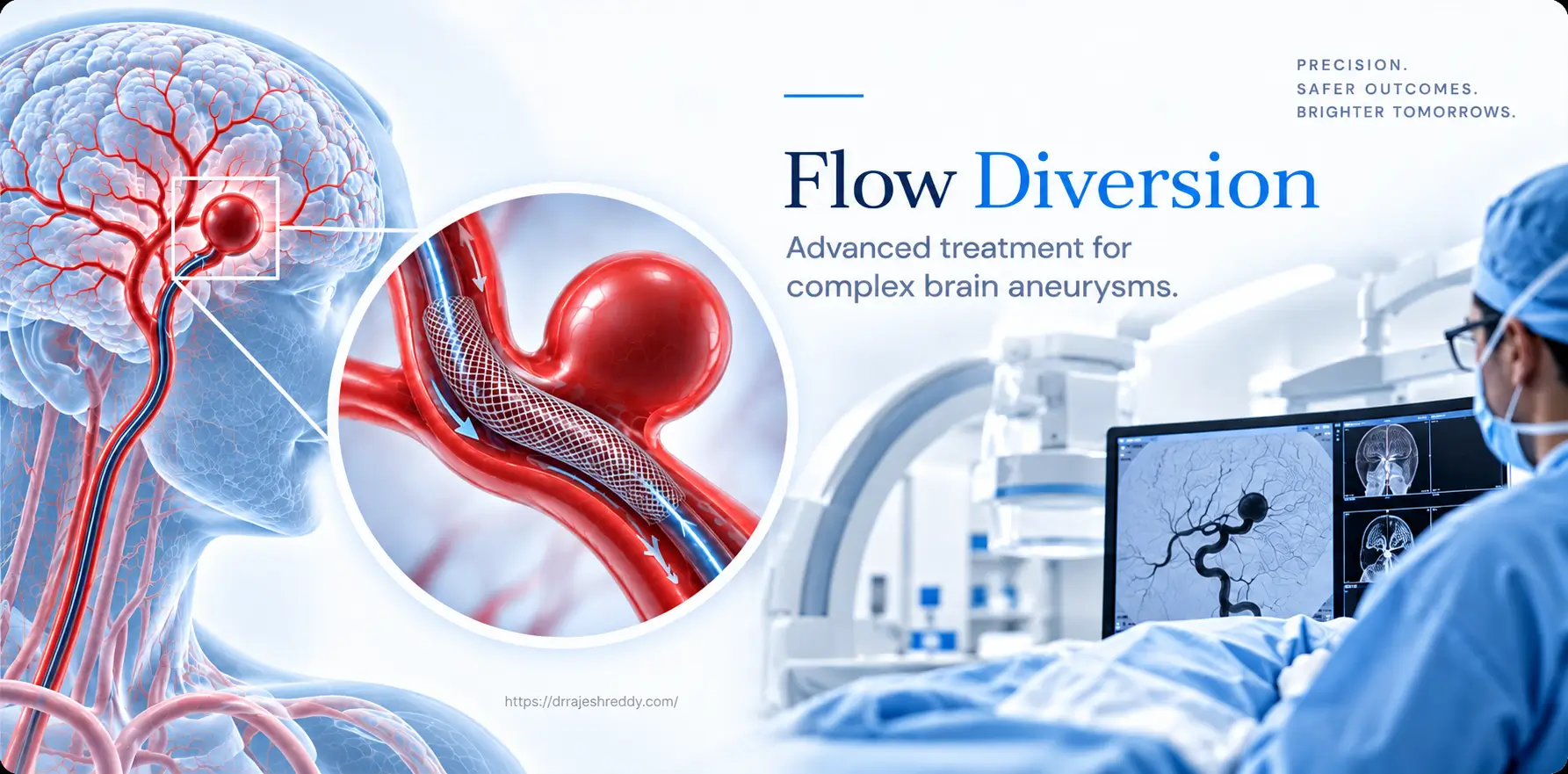 Flow Diversion Treatment for Brain Aneurysms