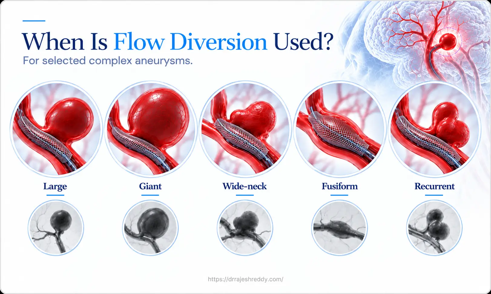 When Is Flow Diversion Used for Brain Aneurysms