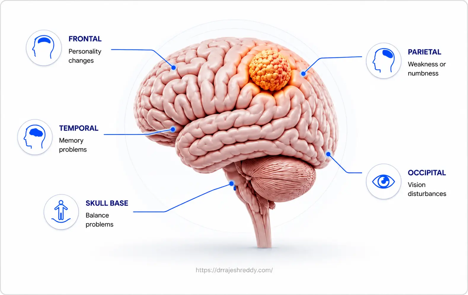 Meningioma Locations in the Brain