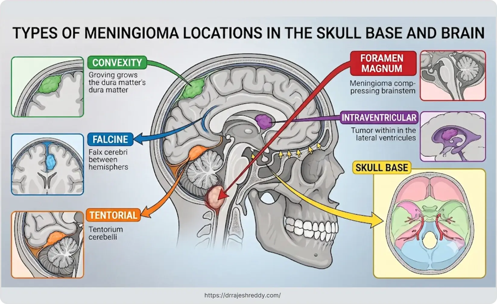 Types of Meningioma