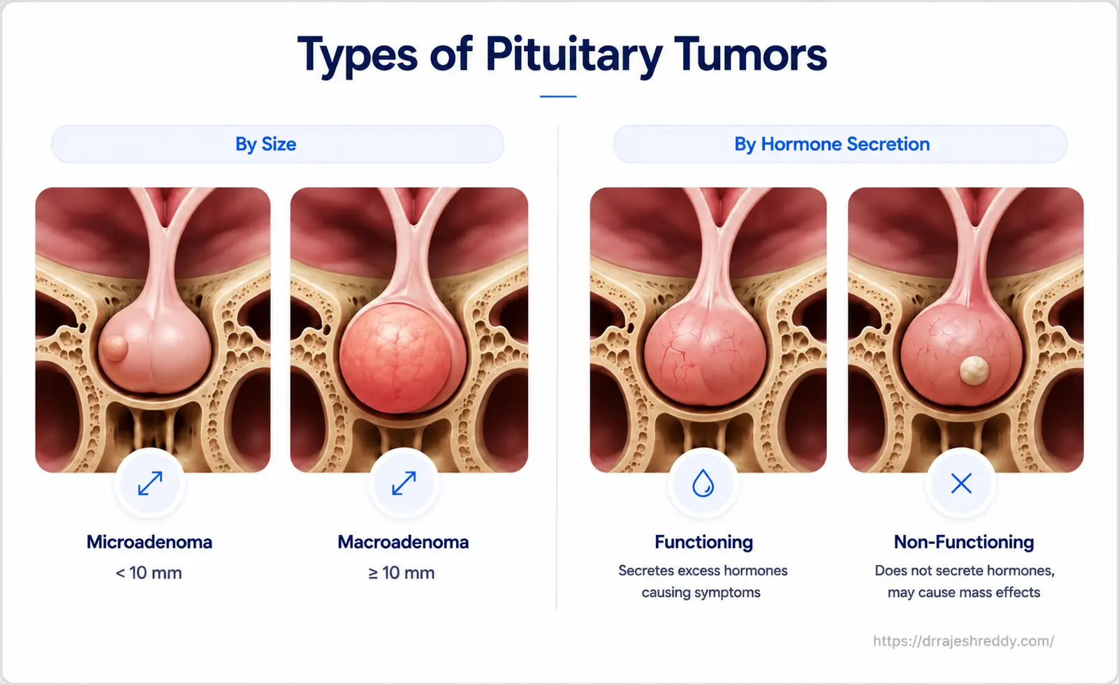 Types of Pituitary Adenomas & Classification