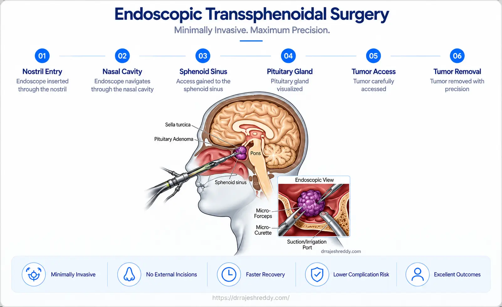 Endoscopic Transsphenoidal Pituitary Surgery Surgical Steps