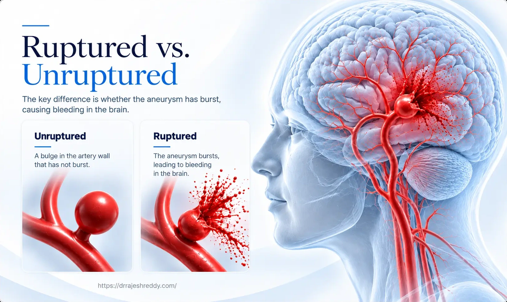 Risk Factors for Brain Aneurysms