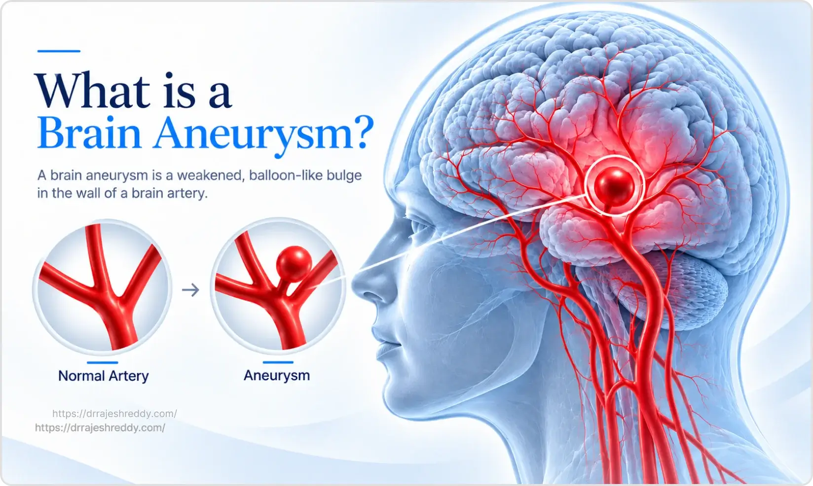 Brain Aneurysm Anatomy